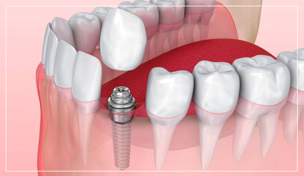 single-implant