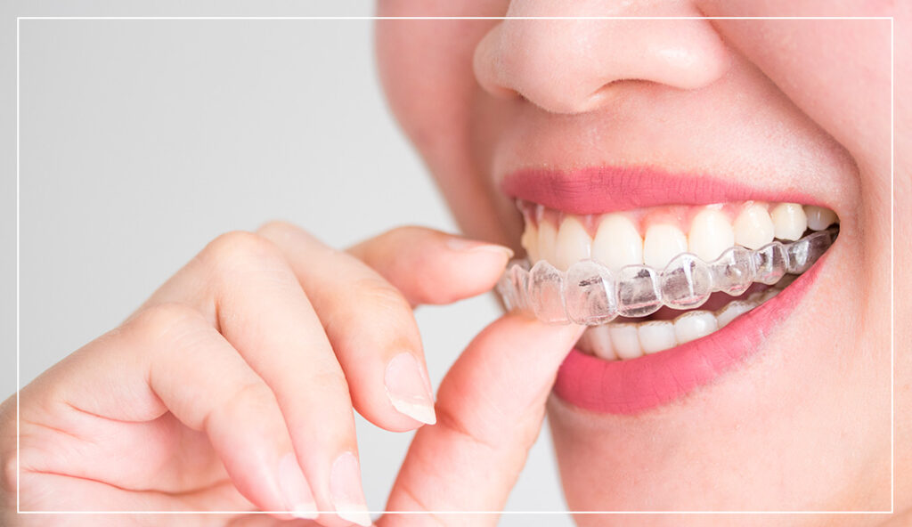 invisalign