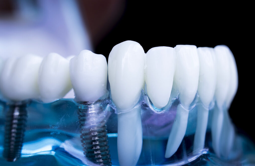 Dental Implants