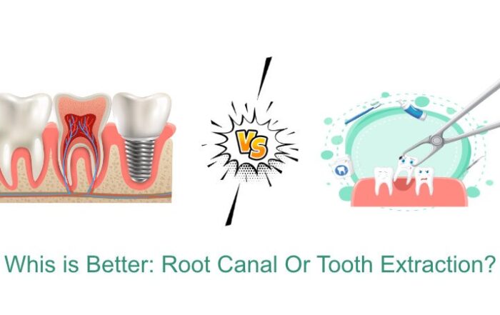 Root Canal vs Tooth Extraction