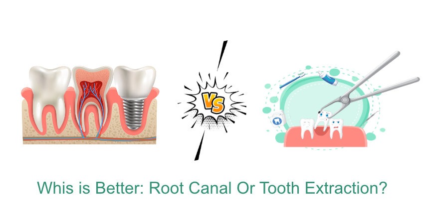 Root Canal vs Tooth Extraction