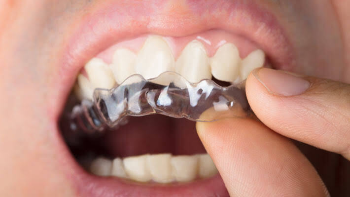 Invisalign® for Crowded Teeth