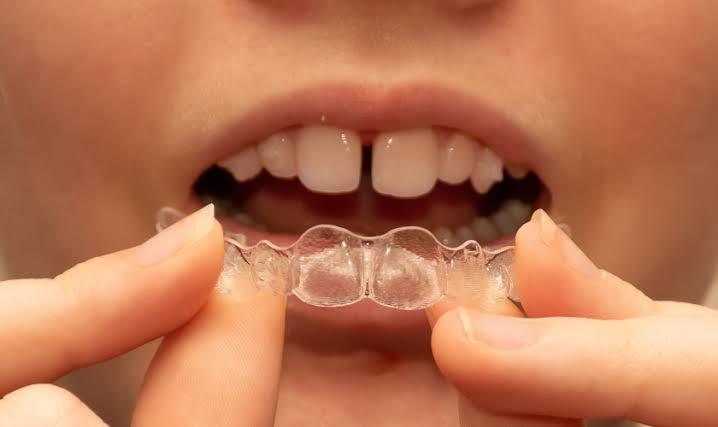 Invisalign® for Gaps