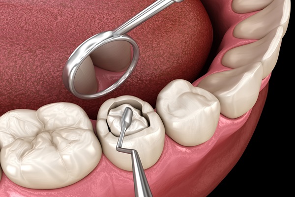 dental filling