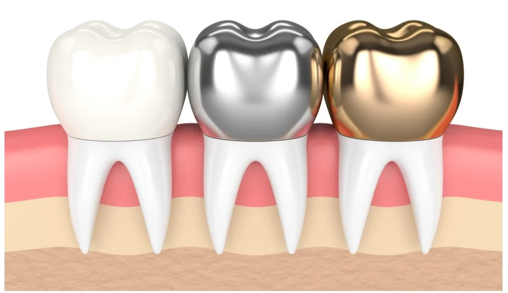 tooth colored crowns