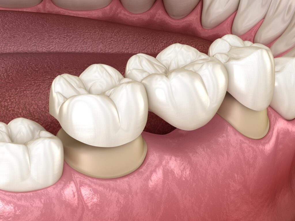 traditional dental bridges