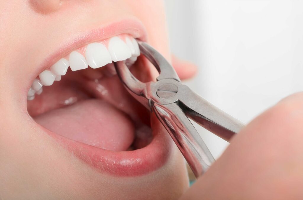 when tooth extraction is recommended